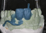 Figure 17 After the wax cooled, the matrix was removed, revealing wax copies of the provisional restorations.