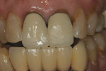 Figure 2 After elimination of posterior interferences, reduction of the incisal edge of tooth No. 8, and addition of length with composite to tooth No. 9, there was incisal contact in protrusive.