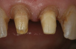 Figure 4 After the crown and secondary decay were removed, the margin was prepared to the height of the gingiva.