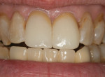 Figure 18 Confirmation of incisal contact when the patient went into protrusive movement.