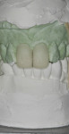 Figure 16 The mounted maxillary and mandibular models.