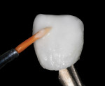 Figure 6 A second layer of incisal porcelain is applied in a greater amount to counter the shrinkage factor during the firing phase.