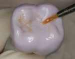 Figure 10 After finishing, external staining was applied.