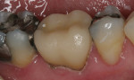 Figure 11 Postoperative view. Before the crown was cemented, it had been placed in a ceramic oven that reached a temperature of 850°C. At this temperature, crystallization of the ceramic occurs, resulting in a change of lithium metasilicate to disilicate.
