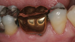 Figure 8 Preoperative view of a gold crown requiring replacement as a result of secondary decay.