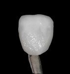 Figure 4 An additional amount of incisal porcelain is applied to account for the densification that occurs during the firing cycle.
