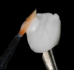 Figure 3 Leucite-reinforced incisal porcelain is placed in the incisal region.
