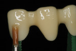 Figure 16 A coat of shade base stain is applied to the zirconia substructure and fired before applying the veneering porcelain.