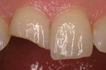 Figure 1 and Figure 2 A clinical situation of a fractured tooth in an emergency situation (Fig 1). The tooth was restored on the same day following a multiple layering technique of composite resins (Fig 2). A dentin-like composite material was used to produce opacity; an enamel-like composite material provided translucency.