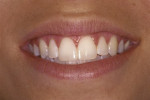 Figure 3 and Figure 4 Female patient was unhappy with the diastema between her central incisors (Fig 3). The diastema was closed in one appointment using composite resin (Fig 4). No preparation of tooth structure was required.