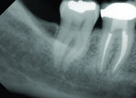 Figure 2 (1 of 2) Comparison of 2D and 3D CBCT slice of complex anatomy in tooth No. 30. Two canals in the mesial root are clearly visible on the 3D CBCT slice.