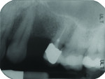 Figure 2 Radiograph of mini dental implant (MDI) site.