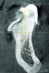 Using digital guided planning, the implant is placed in relation to tooth with the vertical guide pin serving as a reference for vertical dimension and screw access.