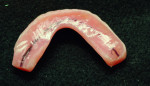 Complete denture flanges are cut back. Note that the black line on the intaglio surface is the crest of the ridge used as a guide to remove acrylic.