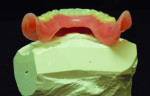 The mounted implant-based master cast is shown with the complete mandibular denture, which will be converted to an implant-supported provisional.