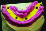 The prosthesis is removed, showing the yellow VPS material that the denture will be converted against during the reline.