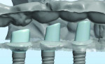 Virtual image of the proposed abutments with soft tissue and opposing dentition.