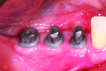Clinical view of the CAD/CAM abutments inserted into the implants.