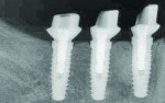 Radiograph confirming that the CAD/CAM abutments were fully seated.