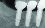 Radiograph confirming that the PFM crowns were fully seated.