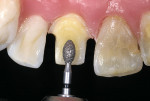 Figure 9  Lingual reduction is accomplished on anterior teeth with the egg-shaped 5379-023 diamond.