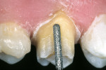 Figure 10  Lingual reduction for posterior teeth is done with a KS1 or KS2 diamond.