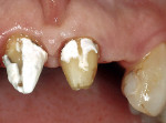 Figure 15  A clinical case immediately after old crown removal.