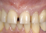 Figure 16  After breaking contact for multiple teeth, preparations were made using a KS1 diamond.
