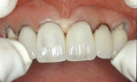 Figure 18  A shell prototype is tried over the rough prepared teeth to assess esthetic and functional acceptance of the desired anatomical changes.