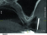 Figure 1 CBCT radiograph pretreatment demonstrating insufficient osseous height for implant placement without sinus augmentation in the molar region.