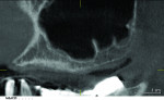 Figure 2 CBCT radiograph pretreatment demonstrating insufficient osseous height for implant placement without sinus augmentation in the molar region.