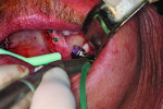 Figure 6 Final Dome drill with a 2.5-mm stopper used to fully expose the sinus membrane.