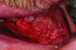 Figure 12 Maxillary sinus has been filled with the osseous graft mixture to a level flush with the exterior lateral wall.