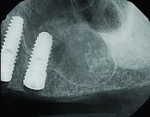 Figure 15 Radiograph immediately after sinus augmentation demonstrating the new osseous height achieved with sinus elevation and grafting.