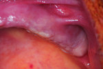 Figure 16 Six months following sinus grafting, the soft tissue shows no inflammation and is ready for implant placement into the grafted tissue.