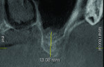 Figure 17 Radiograph 6 months after sinus augmentation demonstrating the new osseous height achieved with sinus elevation and grafting.