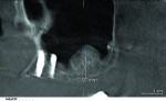 Figure 18 Radiograph 6 months after sinus augmentation demonstrating the new osseous height achieved with sinus elevation and grafting.
