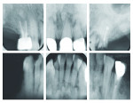 Figure 1 Anterior teeth with periapical cemental dysplasia.