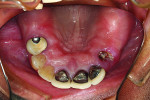Figure 5 Occlusal view of maxillary arch.