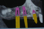 Figure 7 Planned maxillary implants displaying florid osseous dysplasia.