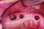 Figure 16 Removal of the healing abutments revealed keratinized gingiva.