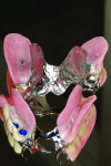 Figure 22 Maxillary and mandibular partial dentures.