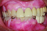 Figure 24 Retracted frontal view showing upper partial denture/lower partial denture/maxillary implant bridge.