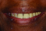 Figure 25 Frontal smile postoperatively.