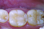 Figure 18 Patient had chief complaint of pain on eating on mandibular first molar. Note the tooth had an occlusal composite resin.