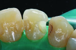 Figure 23 Tooth with remaining defective composite resin in anterior Class III preparation, shown with normal illumination.