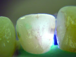 Figure 5 Lingual mirror view: FOTI appearance of mesial surface of maxillary lateral incisor demonstrates shadowing that reveals penetration of caries through enamel into the
dentin.