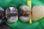 Figure 20 Patient presented with symptomatic maxillary premolar that was suspected on an incomplete tooth fracture.