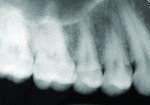 Figure 9 Radiographic view with periapical image is not diagnostic for caries.