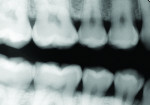 Figure 8 Radiographic view with bitewing radiograph is not diagnostic for caries.